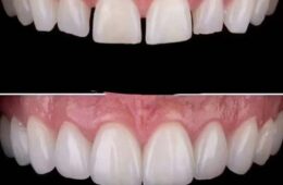 Smile Design in Curaçao | Personalized Cosmetic Dentistry