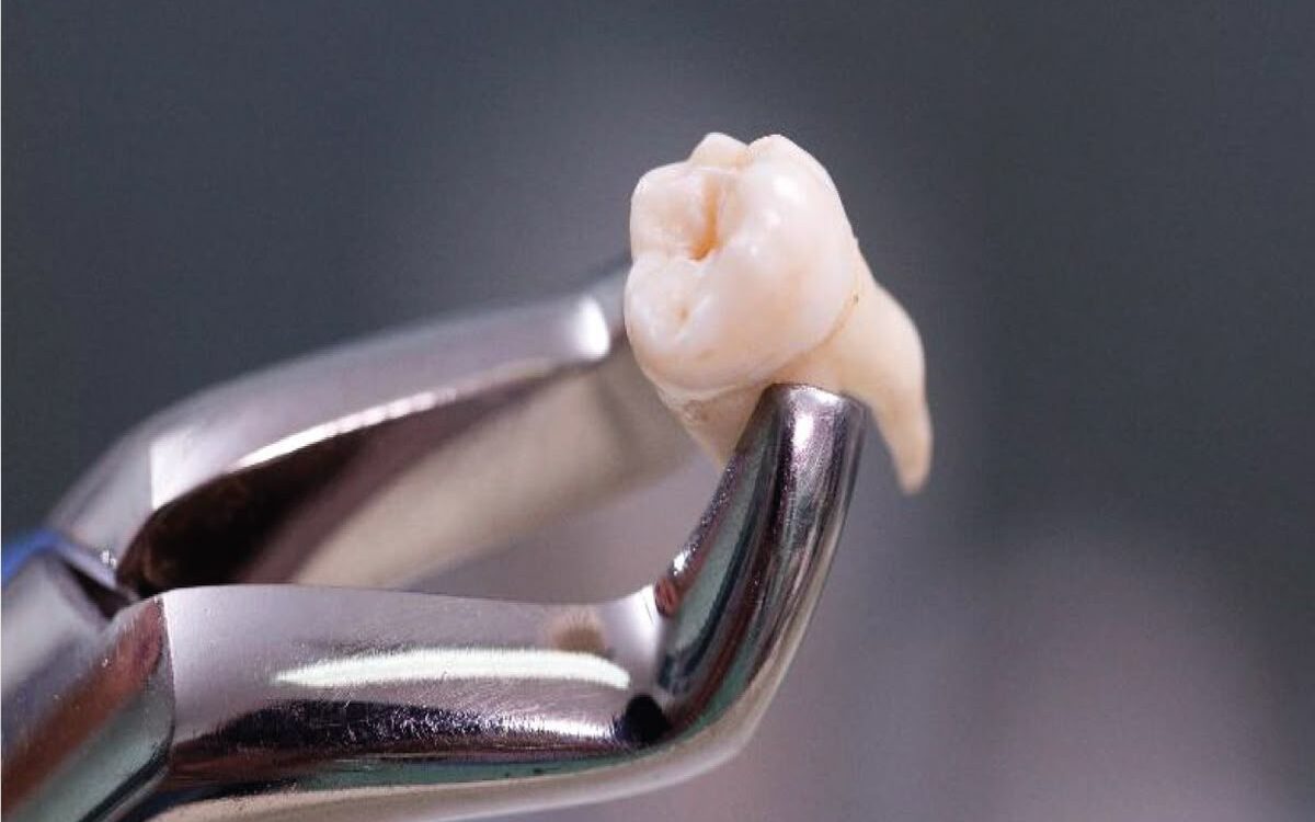 Dentist performing a tooth extraction procedure at a clinic in Curaçao