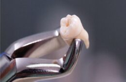 Tooth Extraction Curaçao: What to Expect Before, During & After
