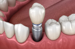 Lost a Tooth? Here’s How Dental Implants in Curaçao Can Give You Your Smile Back Forever