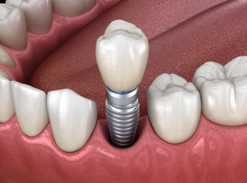 Dental Imants in Curaçao: The Smile You Thought You'd Never Have Again