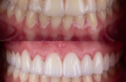 Teeth Whitening Curaçao: 7 Proven Benefits for a Brighter Smile