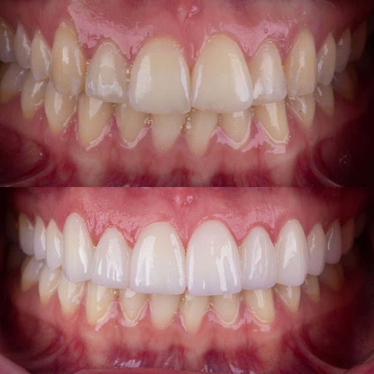 Teeth Whitening Curaçao at Willemstad Dental Group